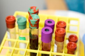 Read more about the article AFP 검사 정상 수치, 높을 때 원인 및 간암 종양 표지자