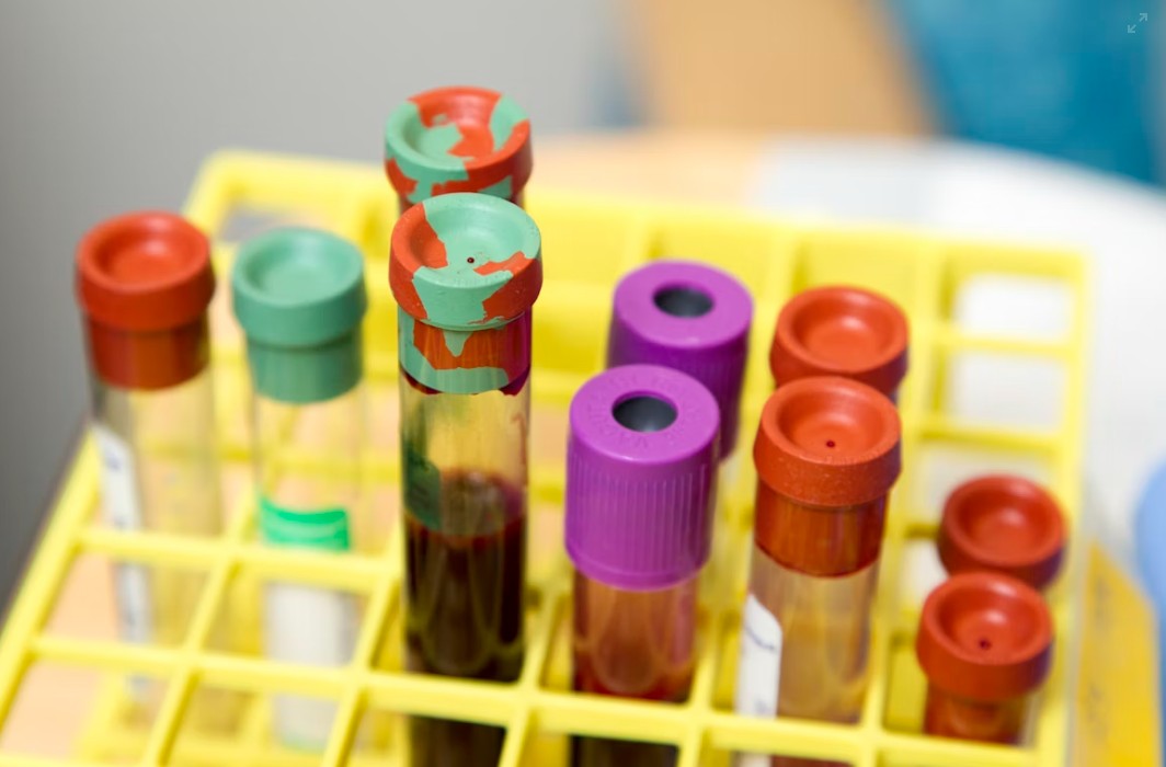 You are currently viewing AFP 검사 정상 수치, 높을 때 원인 및 간암 종양 표지자