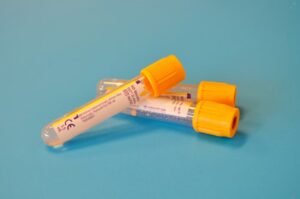 Read more about the article BetaLipoprotein 검사 LDL 콜레스테롤의 임상적 의미와 관리