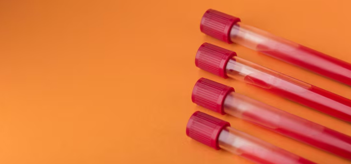 You are currently viewing IgG 검사 – 정상 수치, 높을 때 낮을 때 원인, 식사 방법 및 면역 기능 평가