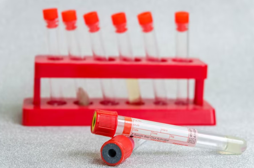 Read more about the article Haptoglobin 검사 정상 수치, 높을 때 낮을 때 원인, 식사 방법 및 용혈 진단