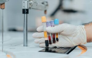 Read more about the article FTA-ABS IgM 매독 정밀 검사 가이드: 최근 감염 및 선천성 매독 진단 기준