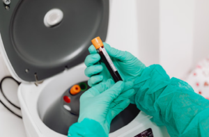 Read more about the article Anti-MPO (P-ANCA) 검사: 미세다발혈관염 진단, 임상적 의의 및 정밀 해석